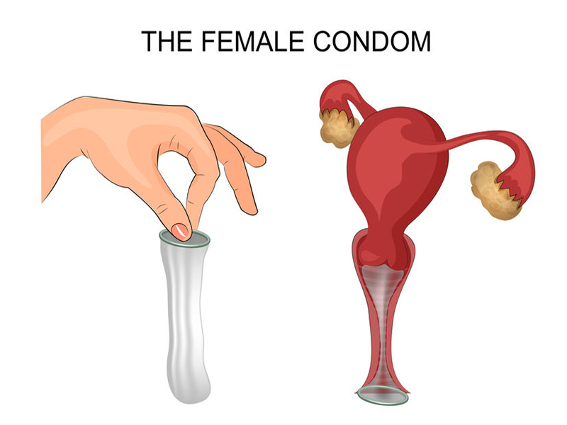 Female Condom Anal